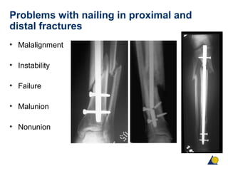 Problems with nailing in proximal and
distal fractures
• Malalignment
• Instability
• Failure
• Malunion
• Nonunion
 