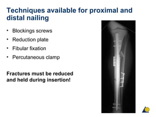 Techniques available for proximal and
distal nailing
• Blockings screws
• Reduction plate
• Fibular fixation
• Percutaneous clamp
Fractures must be reduced
and held during insertion!
 