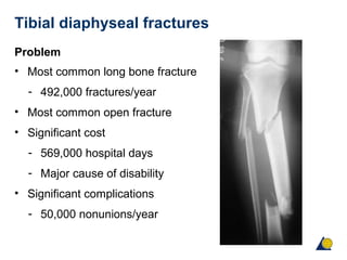 Tibial diaphyseal fractures
Problem
• Most common long bone fracture
- 492,000 fractures/year
• Most common open fracture
• Significant cost
- 569,000 hospital days
- Major cause of disability
• Significant complications
- 50,000 nonunions/year
 