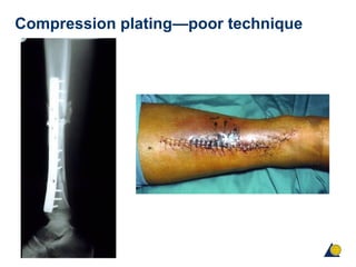 Compression plating—poor technique
 