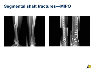 Segmental shaft fractures—MIPO
 