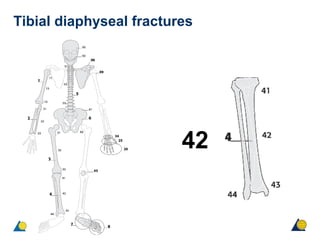 Tibial diaphyseal fractures
42
 