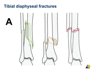 Tibial diaphyseal fractures
A
 