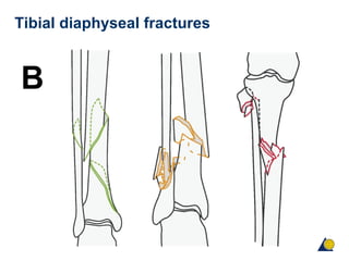 Tibial diaphyseal fractures
B
 