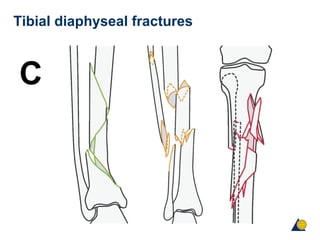 Tibial diaphyseal fractures
C
 