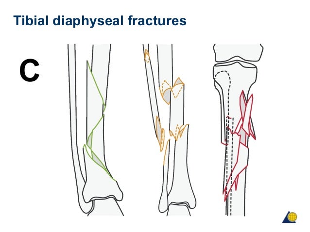 Closed tibial shaft