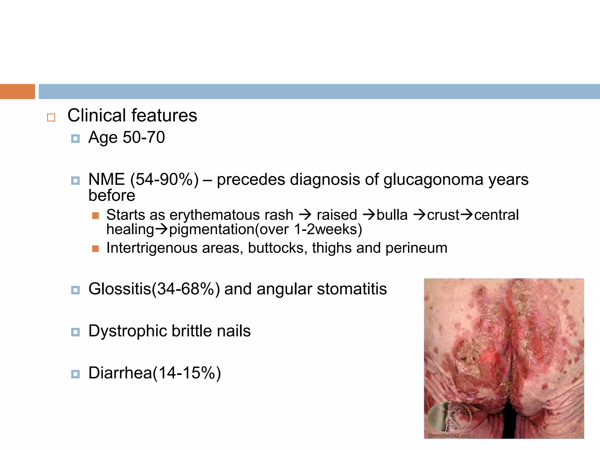 pancreatic neuroendocrine tumors | PPTX