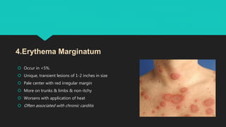  Occur in <5%.
 Unique, transient lesions of 1-2 inches in size
 Pale center with red irregular margin
 More on trunks & limbs & non-itchy
 Worsens with application of heat
 Often associated with chronic carditis
4.Erythema Marginatum
 