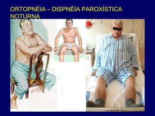 ORTOPNÉIA – DISPNÉIA PAROXÍSTICA
NOTURNA
 
