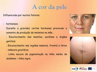 A cor da pele
Influenciada por muitos fatores:
- hormonais;
Durante a gravidez certas hormonas provocam o
aumento da produção de melanina na mãe…
. Escurecimento dos mamilos, auréolas e órgãos
genitais;
. Escurecimento nas regiões malares, frontal e tórax
- máscara gravídica;
. Linha escura de pigmentação na linha média do
abdómen – linha nigra.
 
