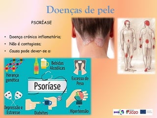 Doenças de pele
PSORÍASE
• Doença crónica inflamatória;
• Não é contagiosa;
• Causa pode dever-se a:
 