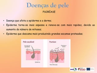 PSORÍASE
• Doença que afeta a epiderme e a derme;
• Epiderme torna-se mais espessa e renova-se com mais rapidez, devido ao
aumento do número de mitoses;
• Epiderme que descama mais produzindo grandes escamas prateadas;
Doenças de pele
 