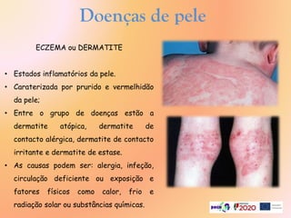 ECZEMA ou DERMATITE
• Estados inflamatórios da pele.
• Caraterizada por prurido e vermelhidão
da pele;
• Entre o grupo de doenças estão a
dermatite atópica, dermatite de
contacto alérgica, dermatite de contacto
irritante e dermatite de estase.
• As causas podem ser: alergia, infeção,
circulação deficiente ou exposição e
fatores físicos como calor, frio e
radiação solar ou substâncias químicas.
Doenças de pele
 