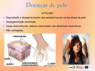 VITILIGO
• Degradação e desaparecimento dos melanócitos em certas áreas da pele;
• Despigmentação localizada;
• Causa desconhecida, embora relacionado com distúrbios imunitários;
• Não contagiosa.
Doenças de pele
 