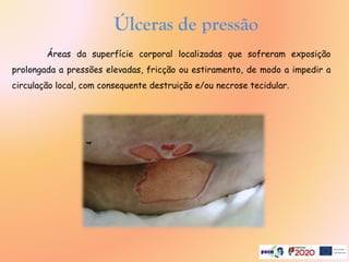 Áreas da superfície corporal localizadas que sofreram exposição
prolongada a pressões elevadas, fricção ou estiramento, de modo a impedir a
circulação local, com consequente destruição e/ou necrose tecidular.
Úlceras de pressão
 