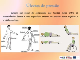 Surgem nas zonas de compressão dos tecidos moles entre as
proeminências ósseas e uma superfície externa ou noutras zonas sujeitas a
pressão contínua.
Úlceras de pressão
 