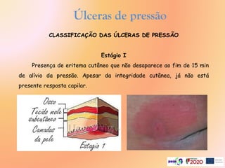 CLASSIFICAÇÃO DAS ÚLCERAS DE PRESSÃO
Estágio I
Presença de eritema cutâneo que não desaparece ao fim de 15 min
de alívio da pressão. Apesar da integridade cutânea, já não está
presente resposta capilar.
Úlceras de pressão
.
 