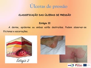 CLASSIFICAÇÃO DAS ÚLCERAS DE PRESSÃO
Estágio II
A derme, epiderme ou ambas estão destruídas. Podem observar-se
flictenas e escoriações.
Úlceras de pressão
.
 