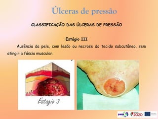 CLASSIFICAÇÃO DAS ÚLCERAS DE PRESSÃO
Estágio III
Ausência da pele, com lesão ou necrose do tecido subcutâneo, sem
atingir a fáscia muscular.
Úlceras de pressão
.
 