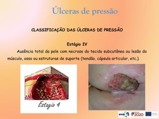 CLASSIFICAÇÃO DAS ÚLCERAS DE PRESSÃO
Estágio IV
Ausência total da pele com necrose do tecido subcutâneo ou lesão do
músculo, osso ou estruturas de suporte (tendão, cápsula articular, etc.).
Úlceras de pressão
.
 