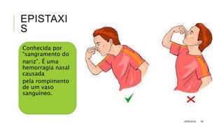 EPISTAXI
S
Conhecida por
“sangramento do
nariz”. É uma
hemorragia nasal
causada
pela rompimento
de um vaso
sanguíneo.
JVRS/2018 50
 