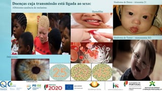 Albinismo-ausência de melanina:
Hemofilia:
Doenças cuja transmissão está ligada ao sexo:
Síndroma de Turner – monossomia XO
Síndroma de Down – trissomia 21
Daltonismo :
 