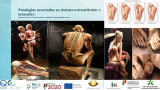 Patologias associadas ao sistema osteoarticular e
muscular:
Fraturas ósseas: Perda parcial ou completa da integridade do osso.
 