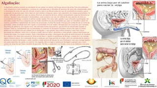 Algaliação:
• A algaliação urinária consiste na introdução de um cateter no interior da bexiga através da uretra. Este procedimento,
tanto diagnóstico como terapêutico, costuma ser solicitado para a obtenção de amostras de urina não contaminadas, para
a eliminação de urina em caso de retenção urinária, para a recolha de urina em caso de incontinência urinária, para a
preparação do paciente para vários tipos de intervenções cirúrgicas e para o pós-operatório da cirurgia geniturinária. As
sondas utilizadas podem ser mais ou menos flexíveis, de material diverso, embora normalmente sejam de borracha ou
silicone. Quando a sua colocação é momentânea, como acontece em caso de colheita de uma amostra de urina ou
esvaziamento da bexiga, costuma se utilizar sondas rígidas. Por outro lado, quando a sua colocação é prolongada, são
utilizadas sondas flexíveis compostas por um balão insuflável na sua extremidade que, após ser insuflado a partir do
exterior, possibilita a manutenção do cateter na sua posição. A urina flui desde a bexiga pela sonda devido ao efeito da
gravidade, sendo recolhida num tubo ligado a extremidade livre da sonda e drenada para um recipiente (por exemplo,
uma bolsa de plástico). Em alguns casos, são utilizadas bolsas descartáveis, que devem ser substituídas quando se
enchem. Todavia, normalmente são recomendados os sistemas de drenagem fechados, através dos quais as bolsas
podem ser esvaziadas sem que tenham de ser desligadas, o que garante uma melhor assepsia e uma mais eficaz
prevenção das infeções. Antes de se colocar a sonda, deve-se lavar e desinfetar a zona genital e aplicar lubrificante no
exterior da sonda e no meato urinário. Após a introdução da sonda, a drenagem das gotas de urina iniciasse de imediato.
Se o objetivo for obter uma amostra de urina ou um único e rápido esvaziamento da bexiga, a sonda deve ser retirada
alguns minutos depois. Se se pretende deixar a sonda por um longo período de tempo, deve ser introduzida de modo a
penetrar no interior da bexiga e, então, insuflar o balão através da injeção de soro fisiológico, com uma seringa ligada a
um canal específico do cateter no exterior. Em seguida, deve-se ligar o sistema de drenagem e garantir que o saco
coletor de urina fica por baixo da púbis do paciente. Por fim, a sonda deve ser fixada a coxa ou ao abdómen com uma
fita adesiva.
30
 