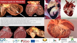 Enfarte Agudo do Miocárdio:
É a consequência da interrupção da circulação do sangue no coração, pela existência de um corpo obstrutivo
(placa aterosclerótica ou coágulo), que não permite a sua irrigação. Isto vai impedir que o músculo receba o
sangue com oxigénio, e por sua vez, morra pela falta deste mesmo oxigénio.
“Causa normalmente uma dor forte no peito, que pode passar para o braço, costas e maxilar.
O doente pode sentir-se enjoado, apresentar suores frios e sensação de desmaio.
Doente com esta patologia exige internamento hospitalar o mais depressa possível para que seja iniciado
tratamento adequado”.
 