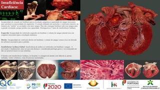 Insuficiência
Cardíaca:
Incapacidade do coração em bombear para a circulação sanguínea a quantidade de sangue necessária
para satisfazer as necessidades do organismo. O coração dilatado tem aurículas e ventrículos maiores, na
tentativa de “encher” as cavidades com mais sangue. Mas não consegue bombear todo esse sangue para
a grande circulação, porque perdeu essa capacidade. Distinguem-se 3 tipos de insuficiência Cardíaca:
Esquerda: Incapacidade do ventrículo esquerdo em bombear o volume de sangue arterial (rico em
oxigénio) necessário para a circulação sistémica.
Direita : Incapacidade do ventrículo direito em bombear o volume de sangue venoso (rico em dióxido
de carbono) necessário para o pulmão.
Insuficiência Cardíaca Global: Insuficiência de ambos os ventrículos em bombear o sangue . A
prevenção é fundamental, uma vez que esta doença é considerada patologia grave e vai avançando até
não ser possível travar os seus sintomas.
O doente com insuficiência Cardíaca, no hospital, é a imagem do doente com falta de ar, pernas
inchadas, ventre volumoso, veias do pescoço aumentadas.
 