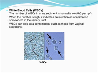 White Blood Cells (WBCs)   The number of WBCs in urine sediment is normally low (0-5 per hpf). When the number is high, it indicates an infection or inflammation somewhere in the urinary tract.  WBCs can also be a contaminant, such as those from vaginal secretions. WBCs 