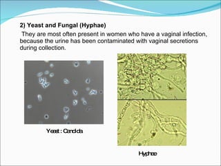 2) Yeast and Fungal (Hyphae)   They are most often present in women who have a vaginal infection, because the urine has been contaminated with vaginal secretions during collection. Hyphae Yeast : Candida 