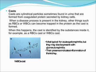 Casts   Casts are cylindrical particles sometimes found in urine that are formed from coagulated protein secreted by kidney cells.   When a disease process is present in the kidney, other things such as RBCs or WBCs can become trapped in the protein as the cast is formed.  When this happens, the cast is identified by the substances inside it, for example, as a RBCs cast or WBCs cast. WBCs cast Most typical for acute pyelonephritis, but they may also be present with glomerulonephritis.  Their presence indicates inflammation of the kidney.  