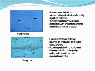 Hyaline cast Have a smooth texture. Are not always indicative clinically significant disease. Greater numbers may be seen associated with proteinuria of renal (such as glomerular disease). Waxy cast Have a smooth consistency, squared off ends, as if brittle and easily broken. Found especially in chronic renal disease, diabetic nephropathy, malignant hypertension and glomerulonephritis. 