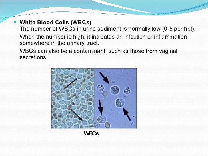 What can cause white blood cells to be in urine?