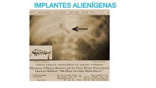 IMPLANTES ALIENÍGENAS
 