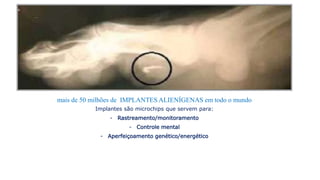mais de 50 milhões de IMPLANTES ALIENÍGENAS em todo o mundo
Implantes são microchips que servem para:
- Rastreamento/monitoramento
- Controle mental
- Aperfeiçoamento genético/energético
 