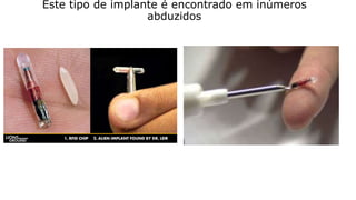 Este tipo de implante é encontrado em inúmeros
abduzidos
 