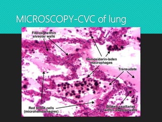 MICROSCOPY-CVC of lung
 