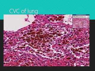 CVC of lung
 