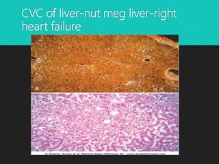 CVC of liver-nut meg liver-right
heart failure
 