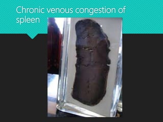 Chronic venous congestion of
spleen
 