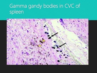 Gamma gandy bodies in CVC of
spleen
 