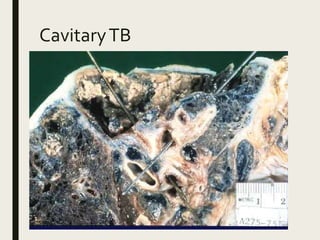 CavitaryTB
 