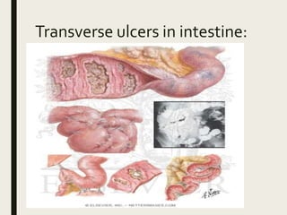 Transverse ulcers in intestine:
 