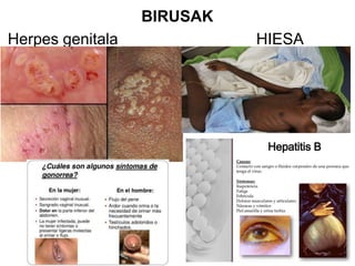 BIRUSAK
Herpes genitala HIESA
 