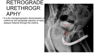  It is the roentgenographic demonstration of
urethra by the retrograde injection of radio-
opaque material through the urethra.
 