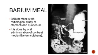 Barium meal is the
radiological study of
stomach and duodenum.
It is done by oral
administration of contrast
media (Barium sulphate).
 