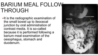 It is the radiographic examination of
the small bowel up to ileocecal
junction by oral administration of
contrast media. It is so-called
because it is performed following a
barium meal examination of the
oesophagus, stomach and
duodenum.
 