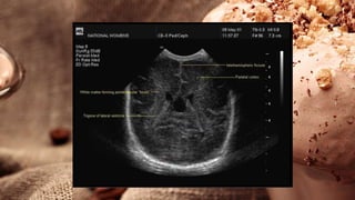 Basics of CT and MRI for Undergraduate | PPTX